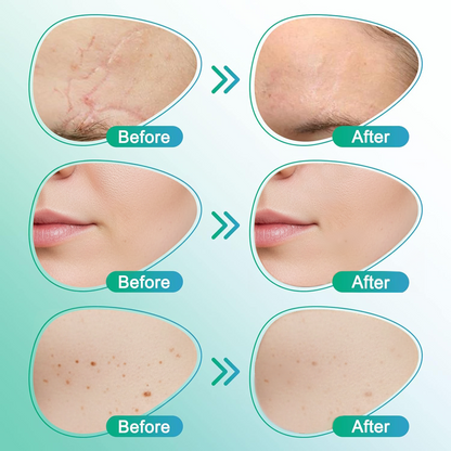 CareBrezza® 3-in-1 Scar Removal Microneedle Care Patch 💡